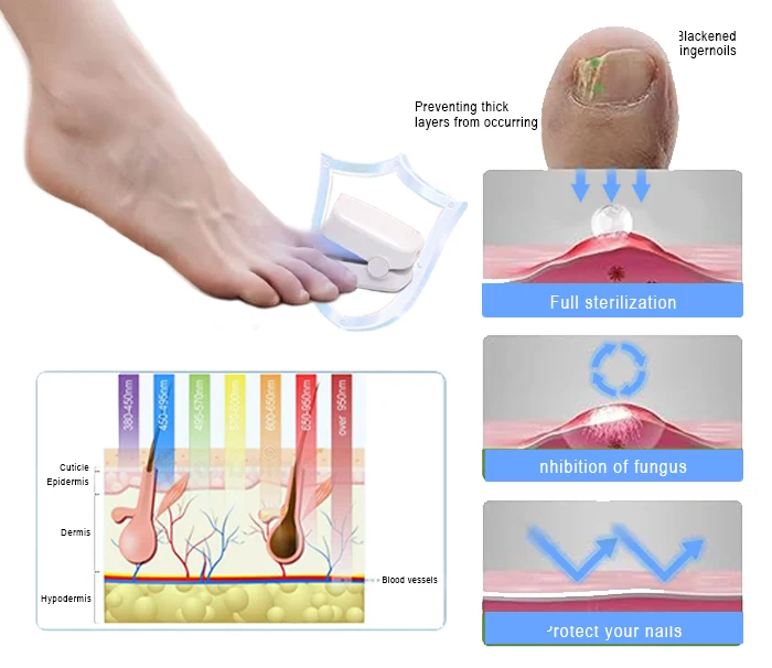 Lichttherapiegerät für Zehennägel mit Blaulicht & Infrarot | 470 nm & 650–1000 nm | Kompakt 90×63×38 mm | Für die Anwendung zu Hause