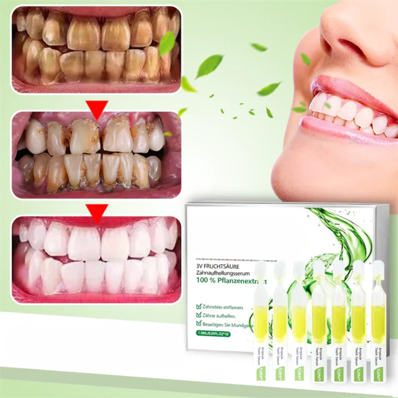 TLOPA Ampullenzahnpasta Whitening 1x | Minzgeschmack | Sanfte Formel | Entfernt Beläge, frischer Atem | 1 Stück, tägliche Anwendung