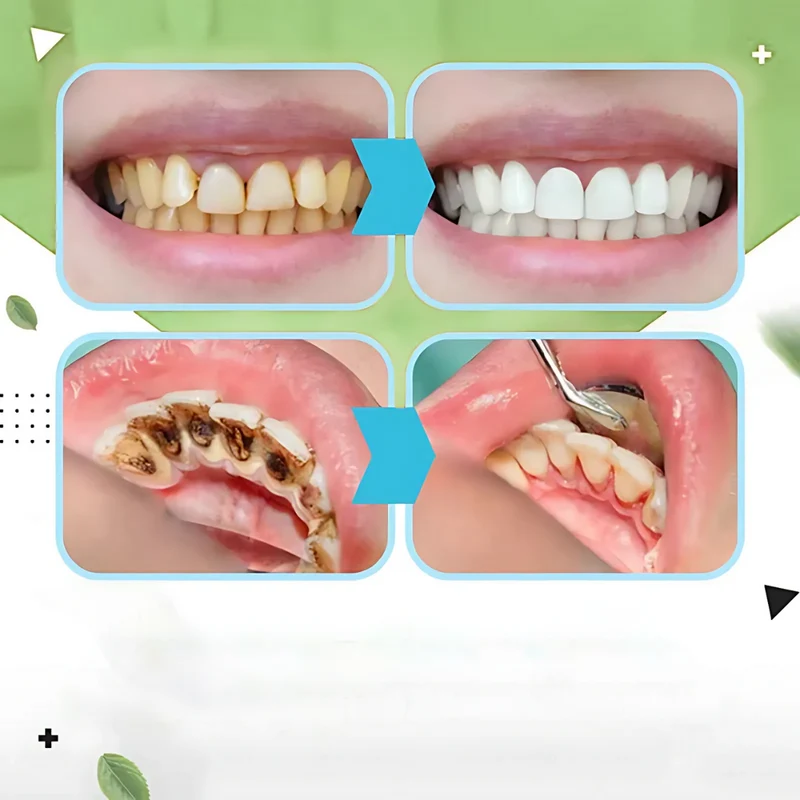 TLOPA Ampullenzahnpasta Whitening 1x | Minzgeschmack | Sanfte Formel | Entfernt Beläge, frischer Atem | 1 Stück, tägliche Anwendung