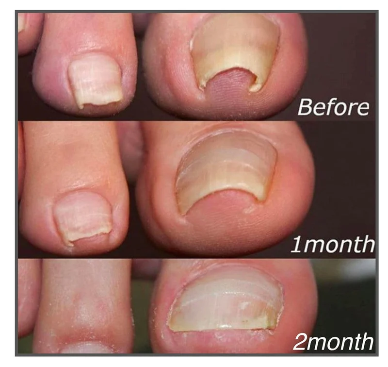Nagelpflege Korrektur-Pflaster | optische Nagel-Ausrichtung & Pflege | selbstklebend | für gepflegt aussehende Zehennägel