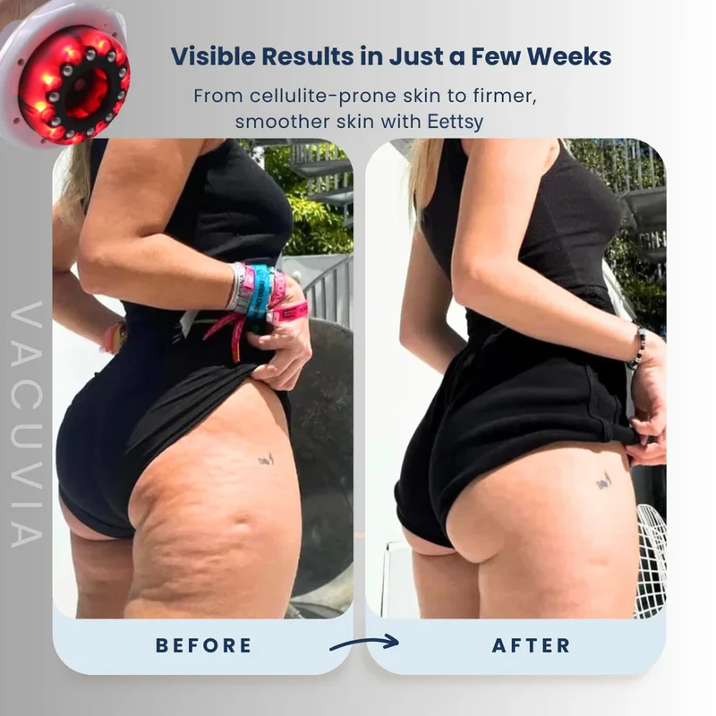 Anti-Cellulite-Vakuum-Massagegerät mit Wärme & Rotlicht | Für ein straffer wirkendes Hautbild | Standard oder Pro