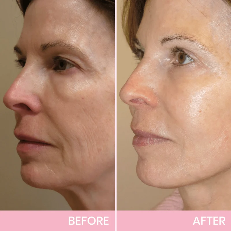 Unsichtbares Face Lift Tape V-Shape | Kinnlinie & Wangen liften | Wasser- & schweißfest
