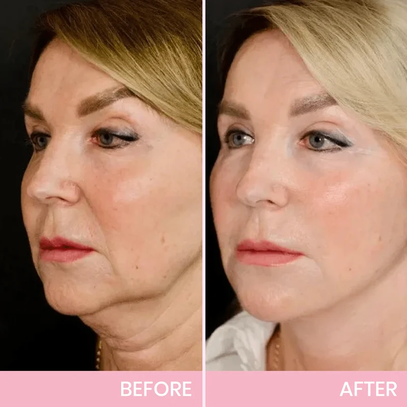 Unsichtbares Face Lift Tape V-Shape | Kinnlinie & Wangen liften | Wasser- & schweißfest