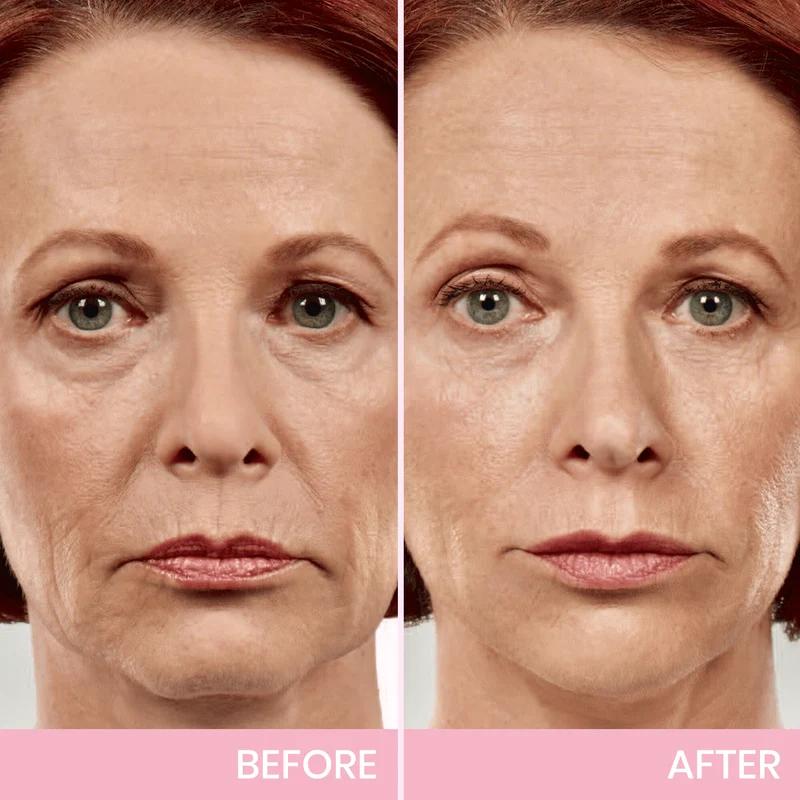 Unsichtbares Face Lift Tape V-Shape | Kinnlinie & Wangen liften | Wasser- & schweißfest
