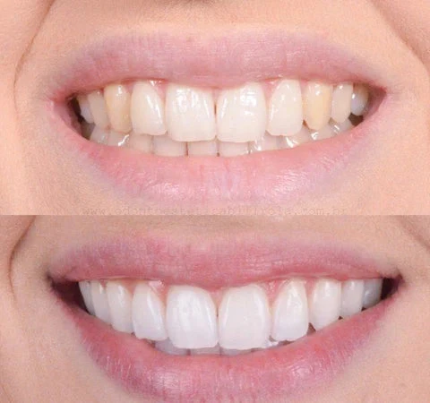 Zahnaufhellungsstift | Präziser Whitening-Stift für die tägliche Zahnpflege
