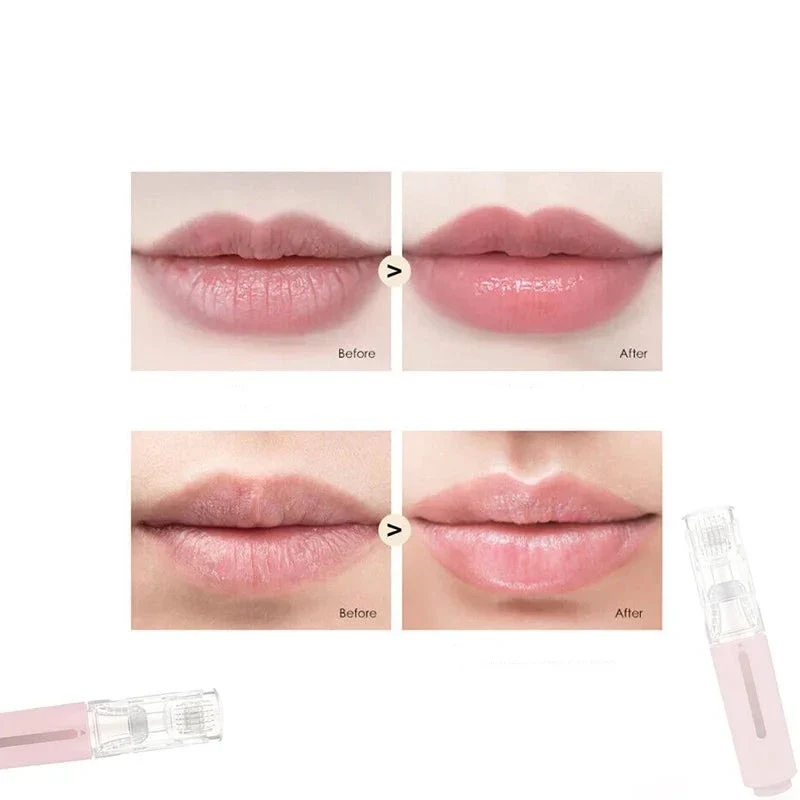 HYDRALIPS - Dermaroller microneedling pour hydrater et repulper vos lèvres