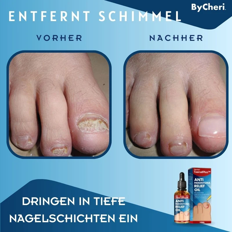 HeilungsTropfenNagelpflege Lösung für beschädigte Nägel | intensive Nagelregeneration & Pflege Tropfen | Unterstützung für gesunde Fuß- & Fingernägel™ Beschädigte Nägel in 4 Wochen wiederherstellen