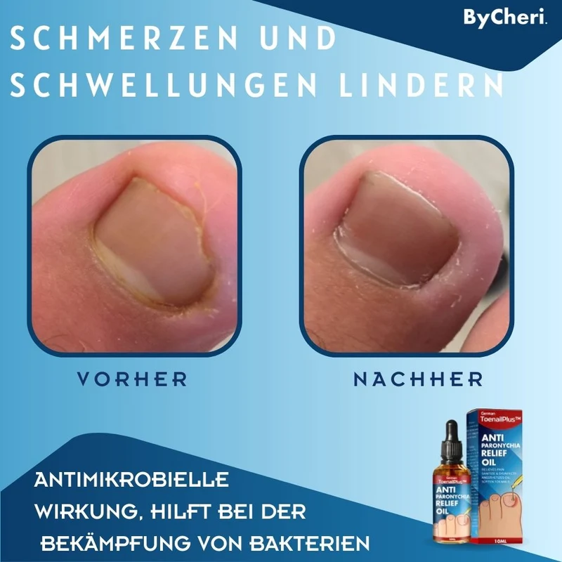 HeilungsTropfenNagelpflege Lösung für beschädigte Nägel | intensive Nagelregeneration & Pflege Tropfen | Unterstützung für gesunde Fuß- & Fingernägel™ Beschädigte Nägel in 4 Wochen wiederherstellen