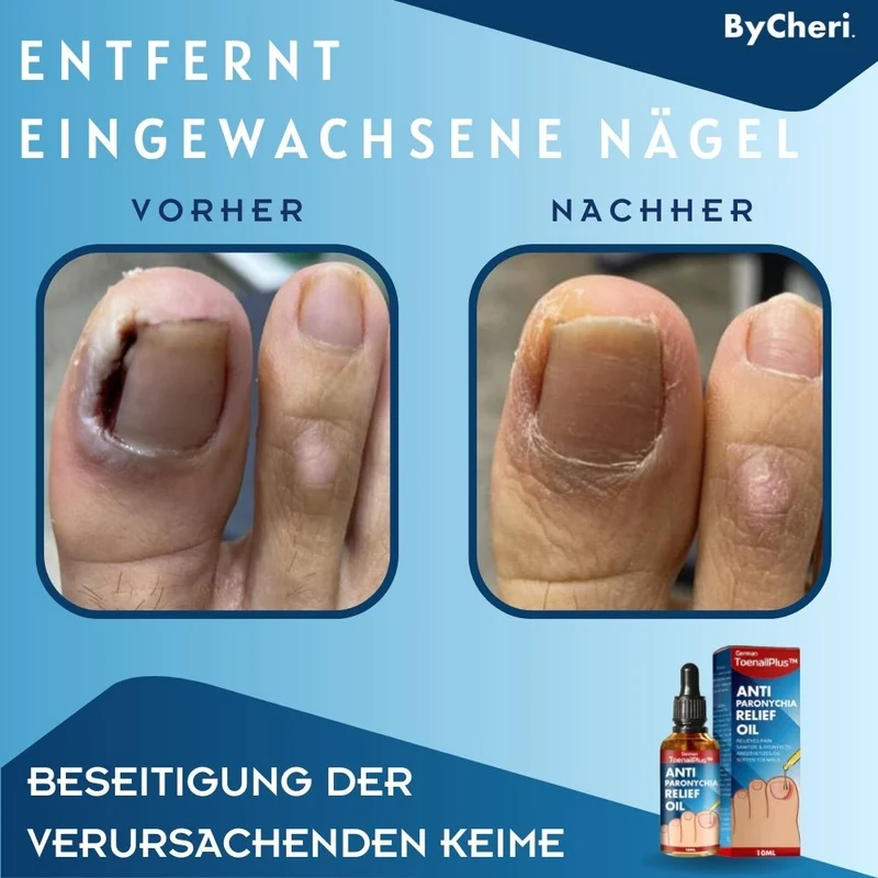 HeilungsTropfenNagelpflege Lösung für beschädigte Nägel | intensive Nagelregeneration & Pflege Tropfen | Unterstützung für gesunde Fuß- & Fingernägel™ Beschädigte Nägel in 4 Wochen wiederherstellen