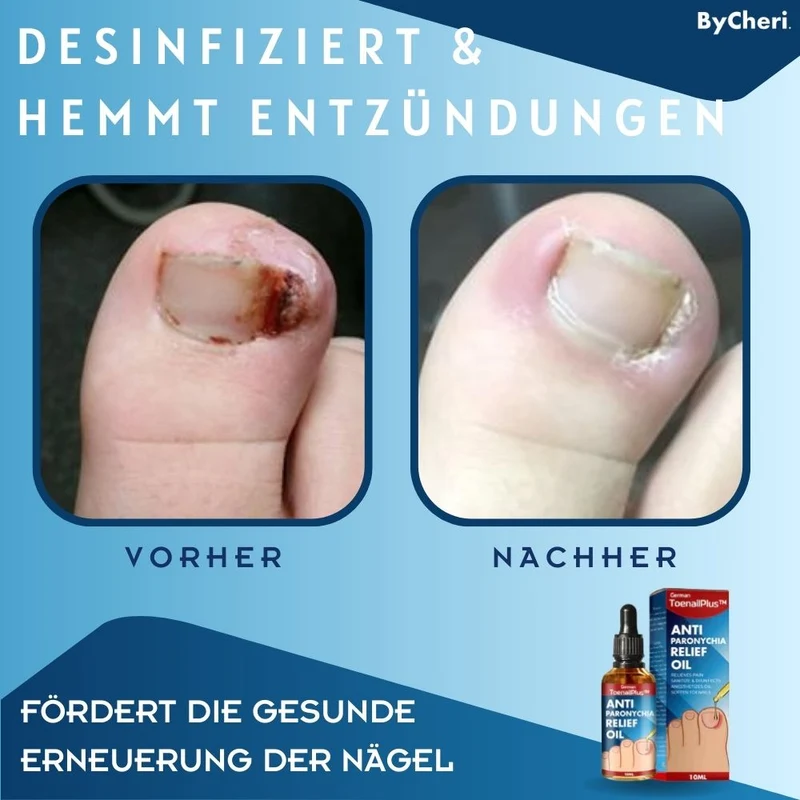 HeilungsTropfenNagelpflege Lösung für beschädigte Nägel | intensive Nagelregeneration & Pflege Tropfen | Unterstützung für gesunde Fuß- & Fingernägel™ Beschädigte Nägel in 4 Wochen wiederherstellen