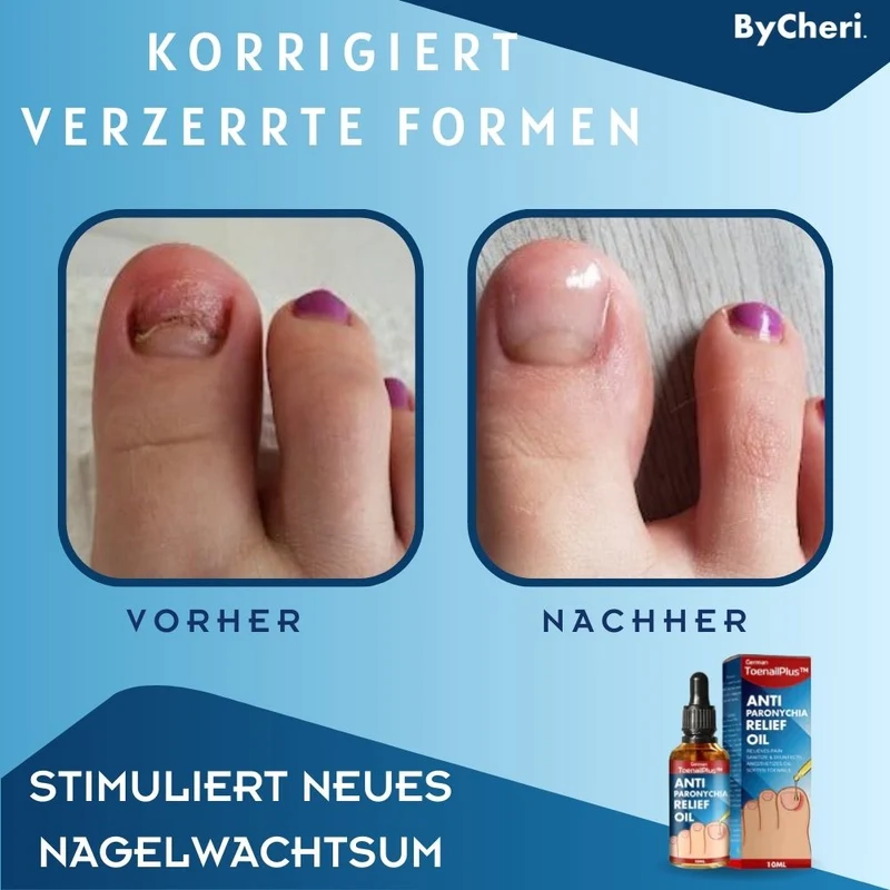 HeilungsTropfenNagelpflege Lösung für beschädigte Nägel | intensive Nagelregeneration & Pflege Tropfen | Unterstützung für gesunde Fuß- & Fingernägel™ Beschädigte Nägel in 4 Wochen wiederherstellen