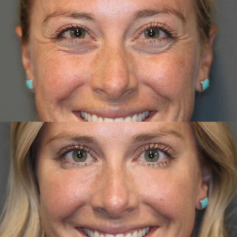 Retinol Augencreme Stick gegen Augenringe & Falten | Anti-Aging Augenpflege mit Squalan & Astaxanthin | glättend & aufhellend | 16g
