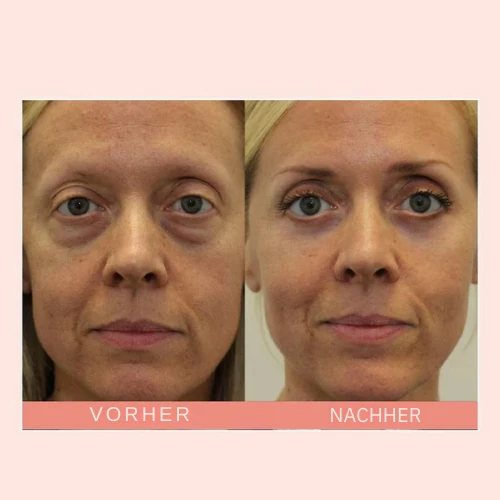 Retinol Augencreme Stick gegen Augenringe & Falten | Anti-Aging Augenpflege mit Squalan & Astaxanthin | glättend & aufhellend | 16g