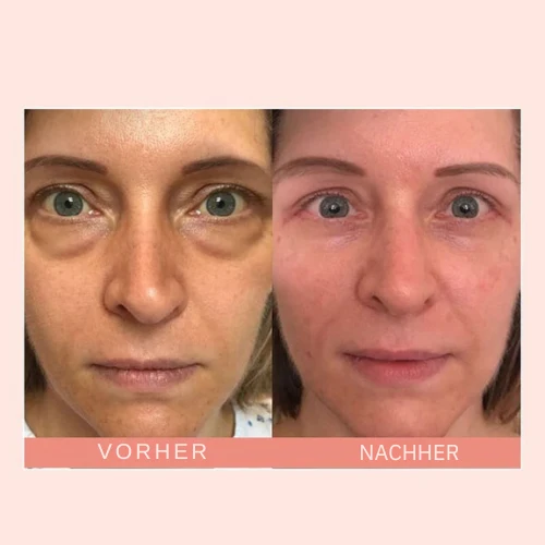 Retinol Augencreme Stick gegen Augenringe & Falten | Anti-Aging Augenpflege mit Squalan & Astaxanthin | glättend & aufhellend | 16g