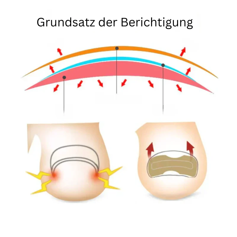 Nagelkorrektur Aufkleber | Behandlung eingewachsener Nägel & Paronychie | Schmerzfreie Nagelpflege