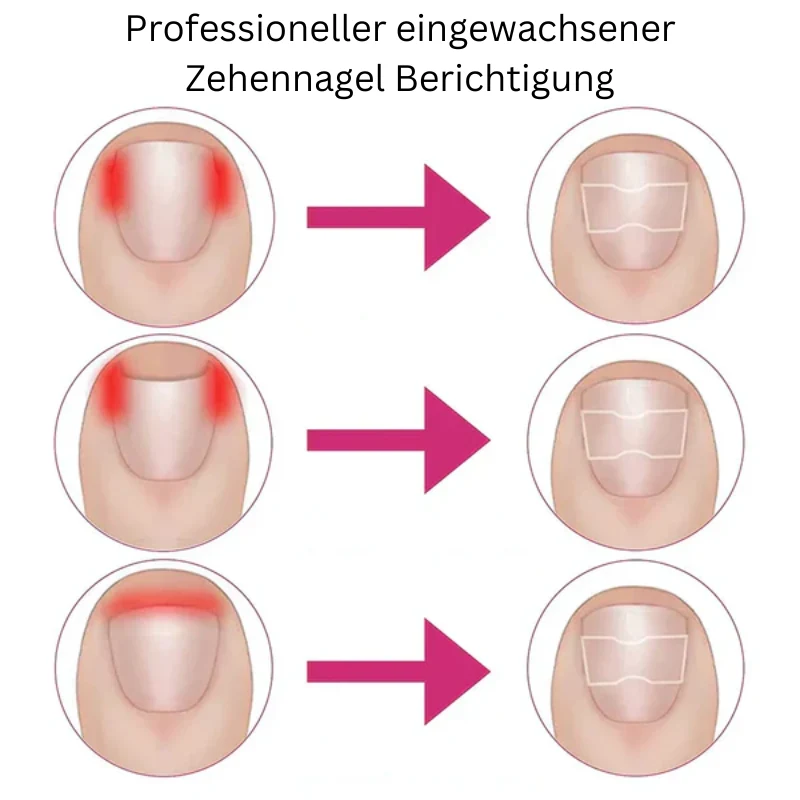 Nagelkorrektur Aufkleber | Behandlung eingewachsener Nägel & Paronychie | Schmerzfreie Nagelpflege