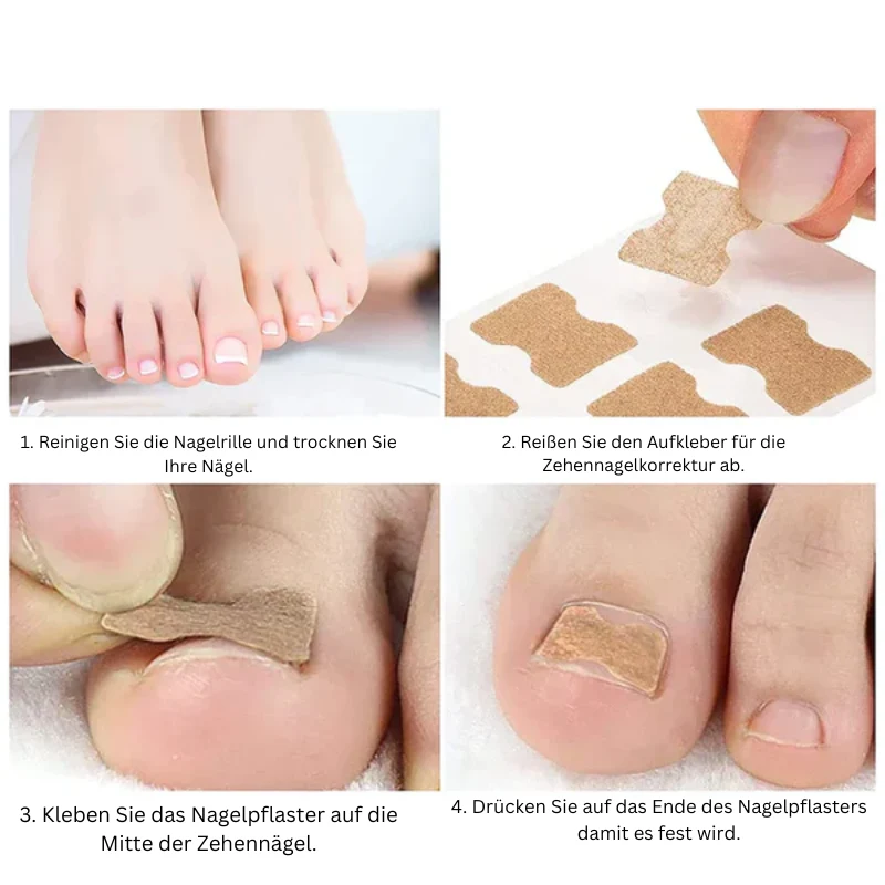 Nagelkorrektur Aufkleber | Behandlung eingewachsener Nägel & Paronychie | Schmerzfreie Nagelpflege