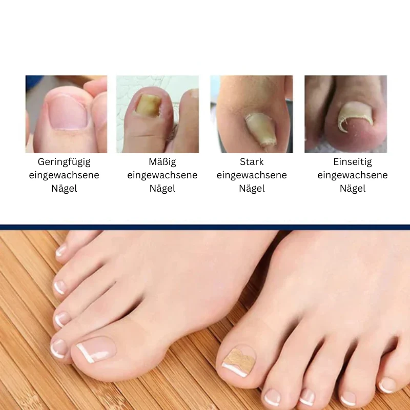 Nagelkorrektur Aufkleber | Behandlung eingewachsener Nägel & Paronychie | Schmerzfreie Nagelpflege