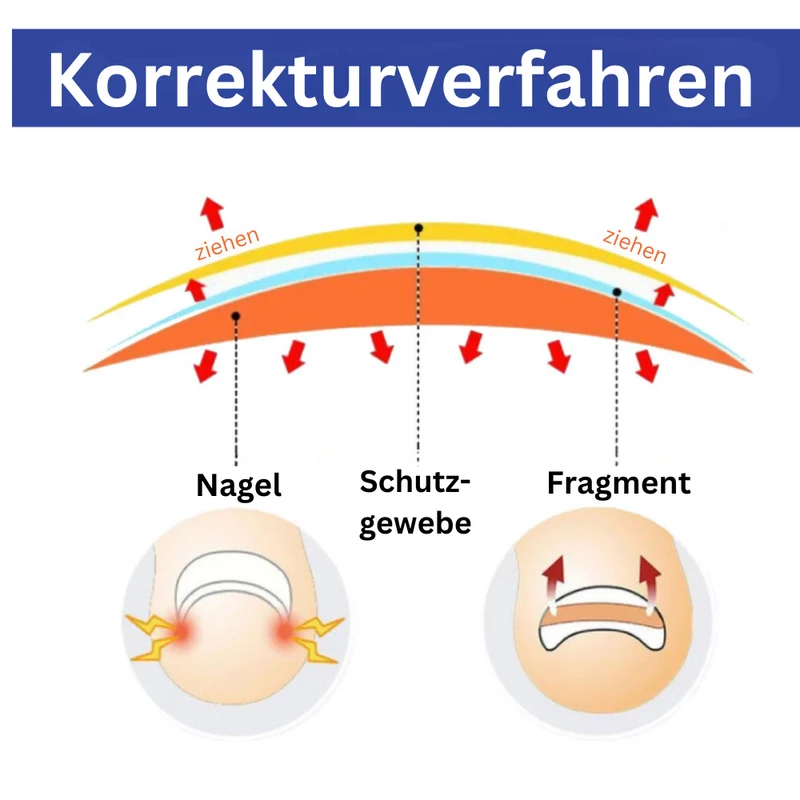 Zehennagel Korrektur Pflaster gegen eingewachsene Nägel | schmerzlindernd & hautfreundlich | Nagelpflege | 50–200 Stück