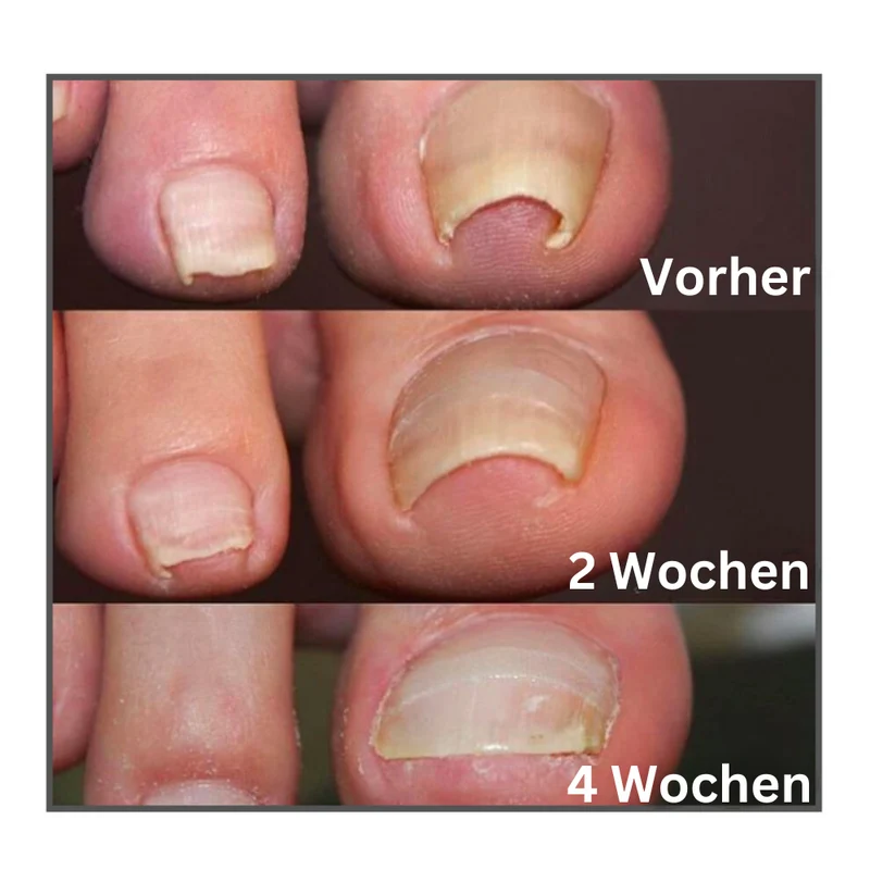 Zehennagel Korrektur Pflaster gegen eingewachsene Nägel | schmerzlindernd & hautfreundlich | Nagelpflege | 50–200 Stück