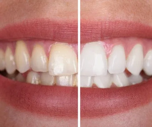 Zahnaufhellungs Gel sanft | Fleckenentfernung für weißere Zähne | Whitening Gel für Kaffee & Tee Verfärbungen