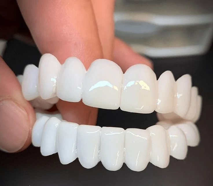 SmileFlex – Protesi dentale con lenti dentali bianche