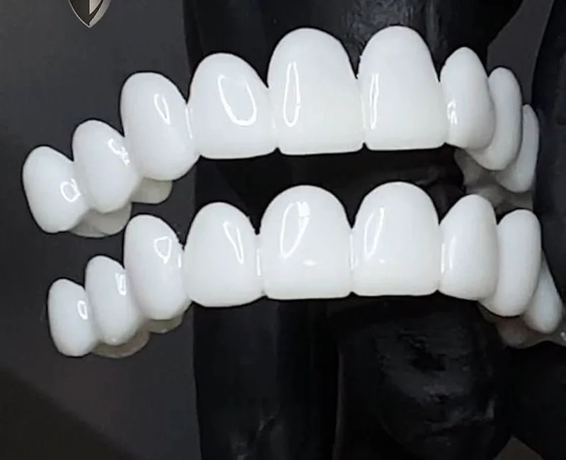 SmileFlex – Protesi dentale con lenti dentali bianche