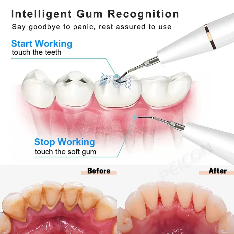 Pulitore per Denti Ultrasone - SonicClean