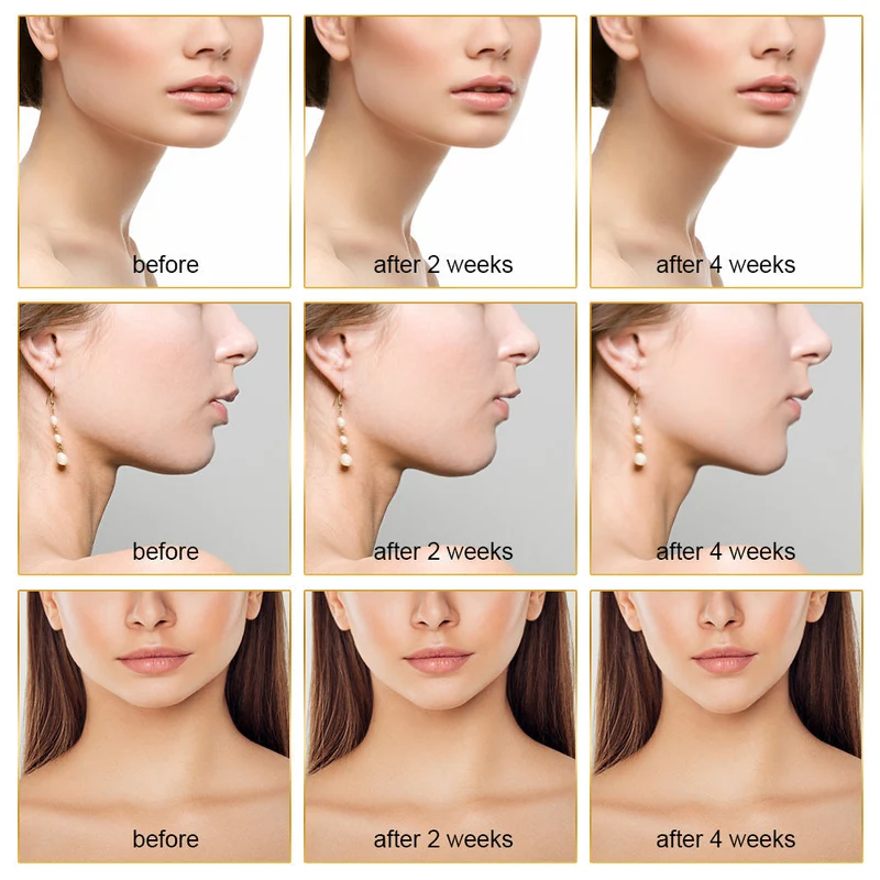 EMS Facial Slimmer con Terapia LED - Snellimento del Viso e Rimozione del Doppio Menton