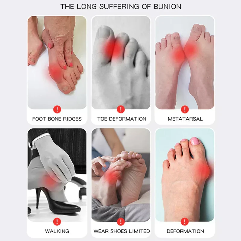 1+1 GRATIS | Hallux Valgus™ | La tua soluzione confortevole per piedi senza dolore!