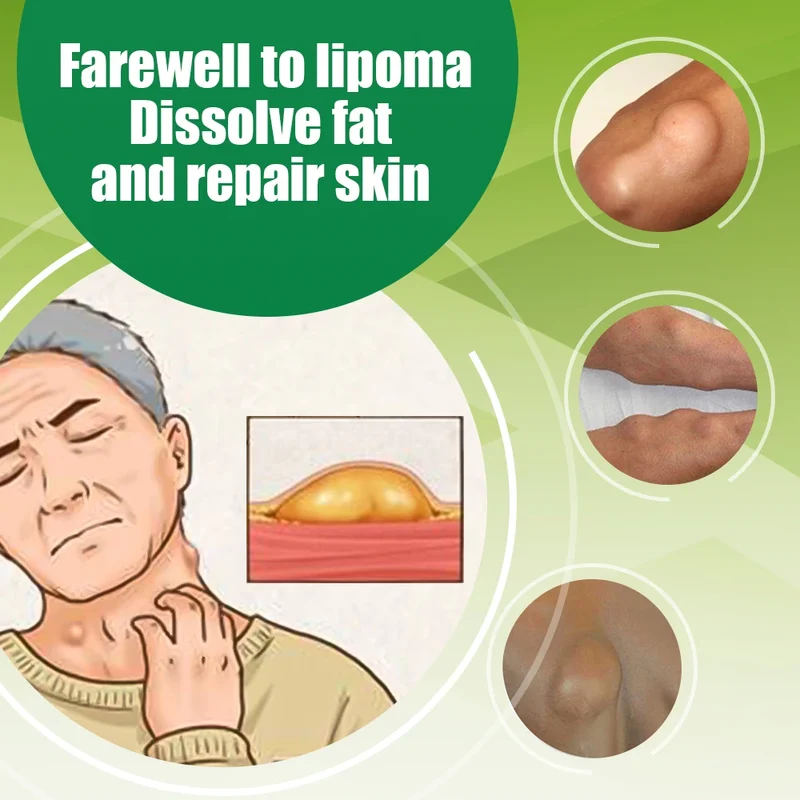 Crème Apaisante de Soin des Lipoemes et Nodosités