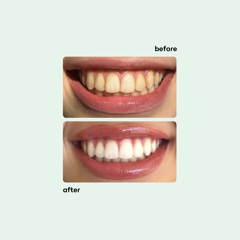 Smilie Boost Teeth Whitening Kit