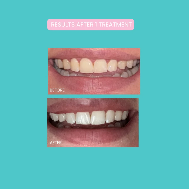 Smilie Boost Teeth Whitening Kit