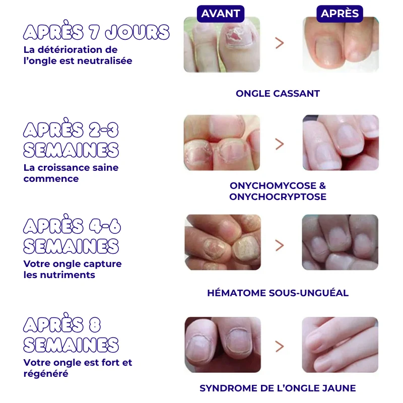 32x Patchs de Traitement Anti-Mycose pour Pieds