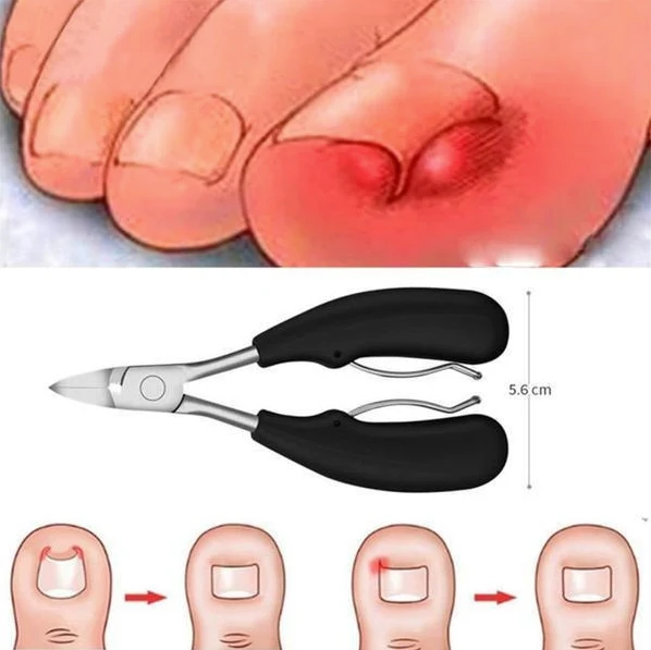 Ensemble de Coupe-ongles pour Ongles Incarnés - 4PCS