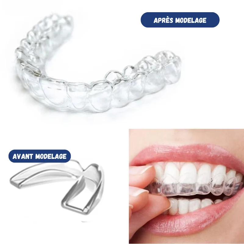 Lot de 4 Gouttières à Modeler Anti-Ronflement