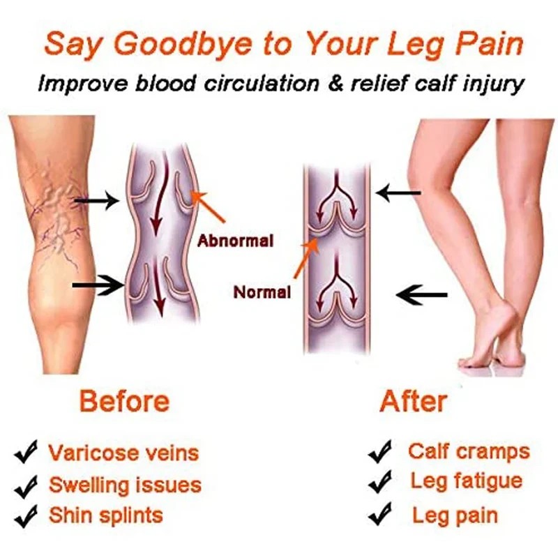 Manchons de Compression Médical pour Mollets - Traitement Varices