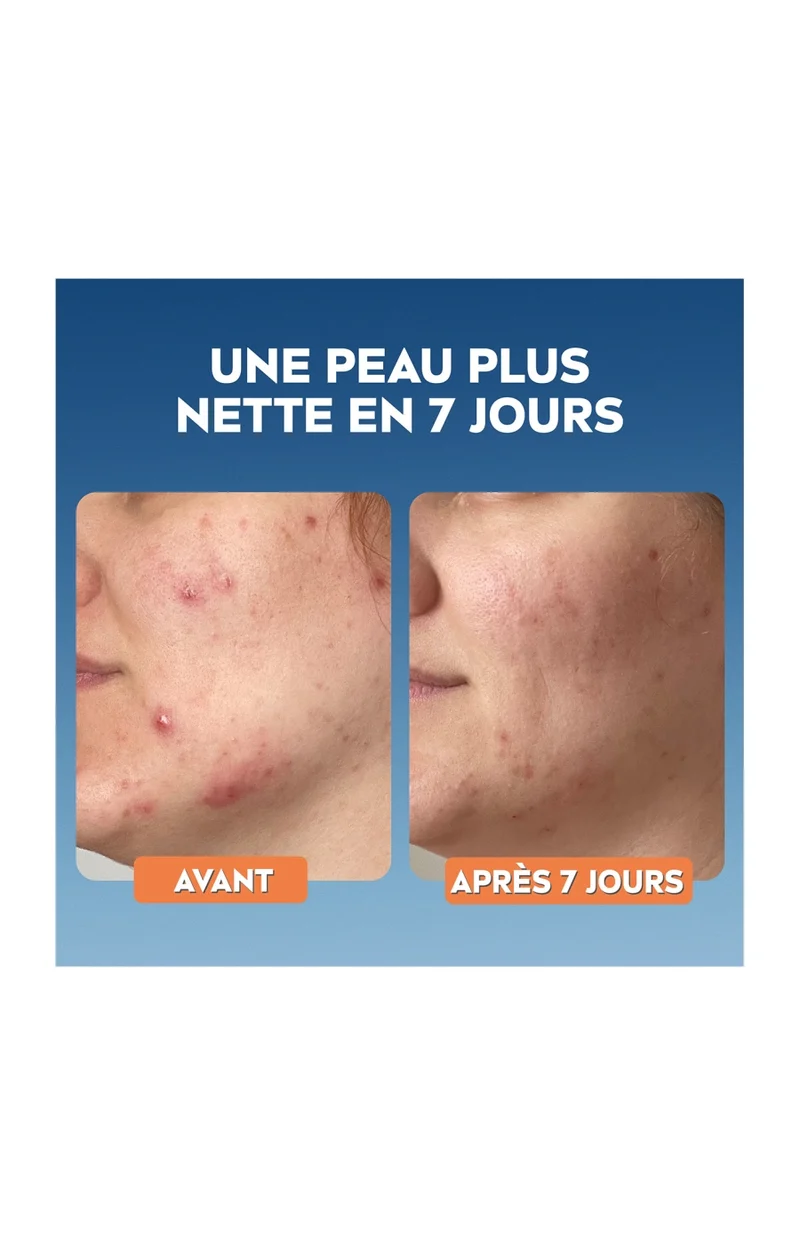 Sérum purifiant - Derma Skin Clear - Niacinamide & acide hyaluronique - Peaux à imperfections - 30 ml
