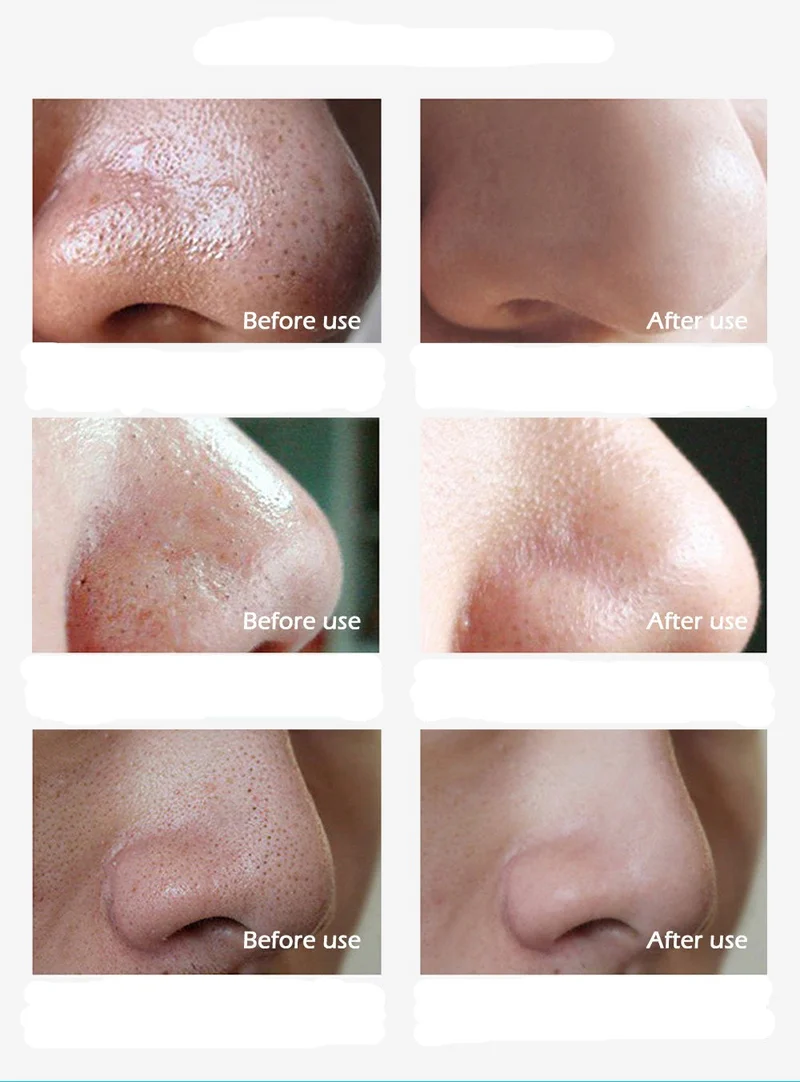 ClearSkin | Rimuovi Punti Neri