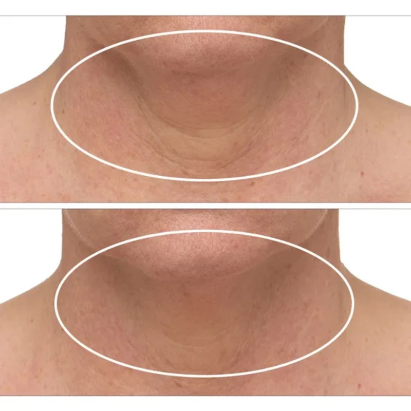 STRIVECTIN - Ensemble de 2 Crèmes Raffermissantes pour le Cou Plus