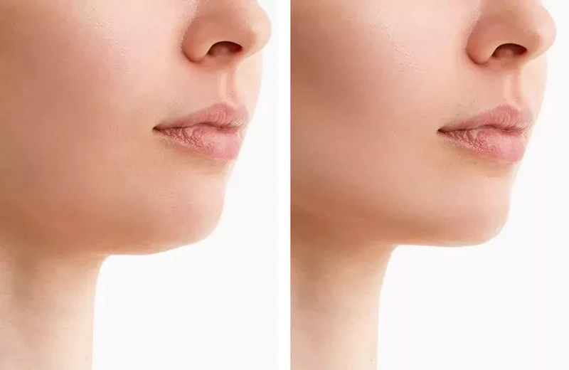 Cintura per Contorno del Mento NovaLume con Luce Rossa per Doppio Mento