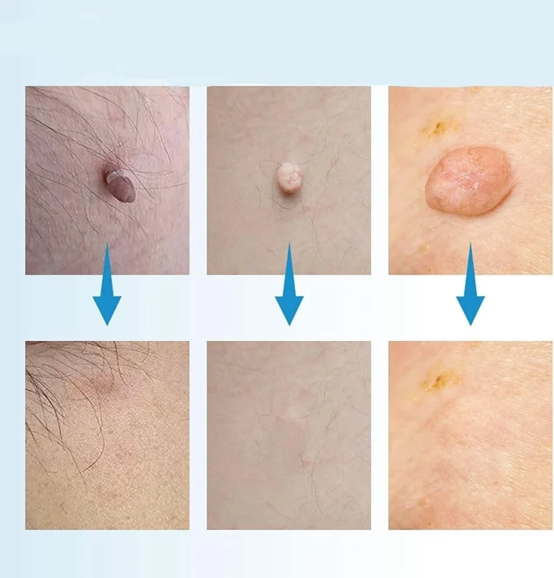 Dermaswift – Rimuovi Macchie Cutanee Contro Verruche e Escrescenze Cutanee