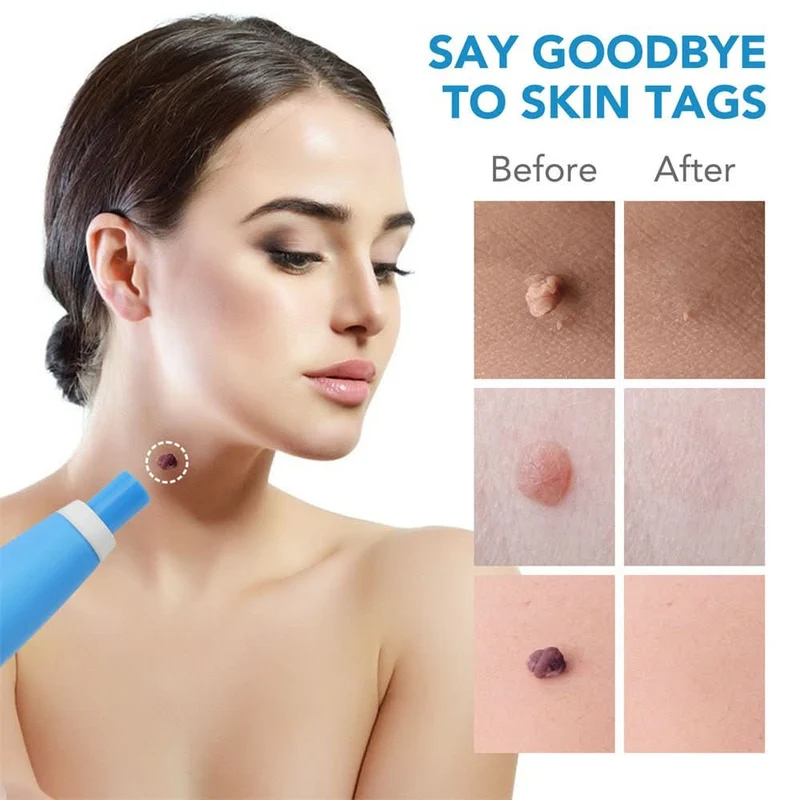Dermaswift – Rimuovi Macchie Cutanee Contro Verruche e Escrescenze Cutanee