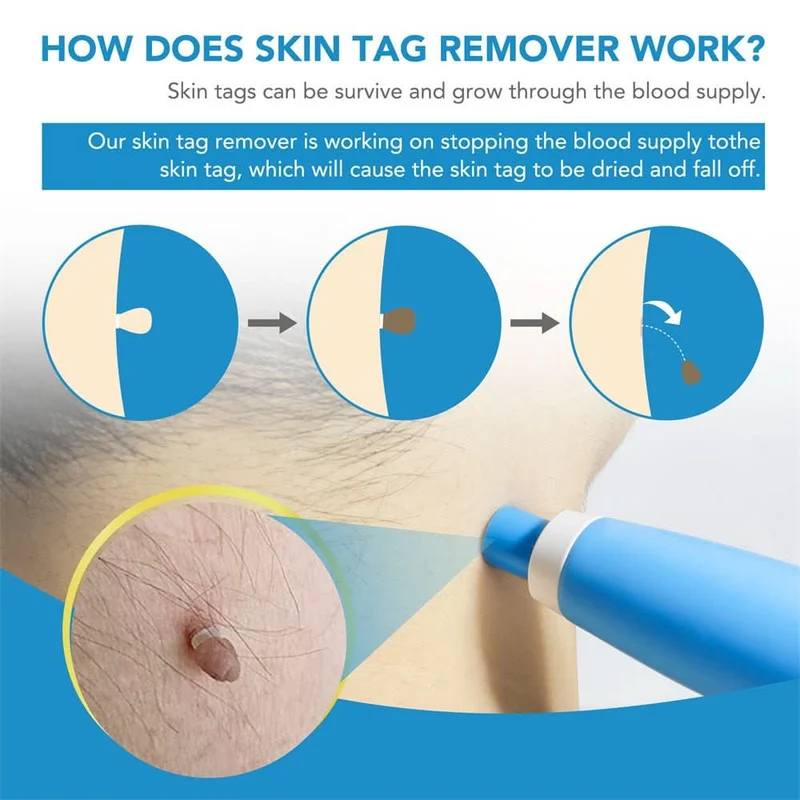 Dermaswift – Rimuovi Macchie Cutanee Contro Verruche e Escrescenze Cutanee
