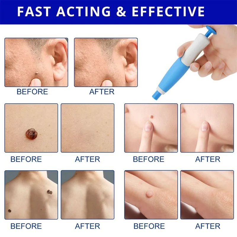 Dermaswift – Rimuovi Macchie Cutanee Contro Verruche e Escrescenze Cutanee