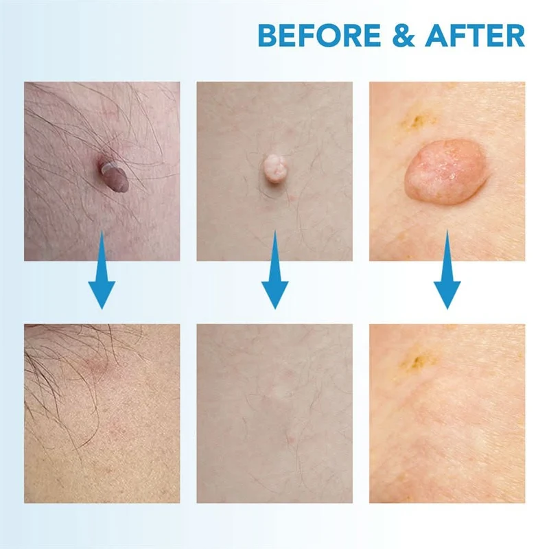 Dermaswift – Rimuovi Macchie Cutanee Contro Verruche e Escrescenze Cutanee