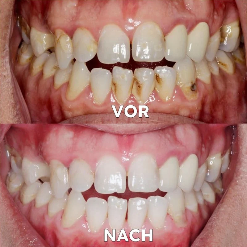 Polvere minerale per la cura dei denti | Rinforza e protegge i denti | SmileSchutz