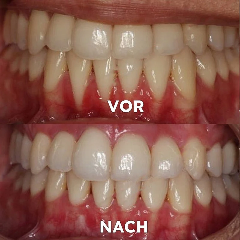 Polvere minerale per la cura dei denti | Rinforza e protegge i denti | SmileSchutz