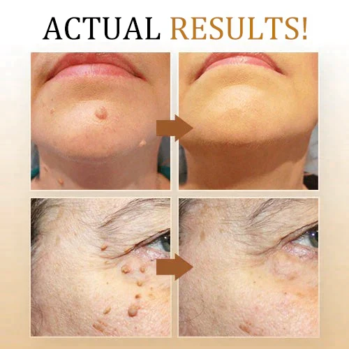 SkinClear | Spray Rimuovi Verri – Trattamento Delicato ed Efficace