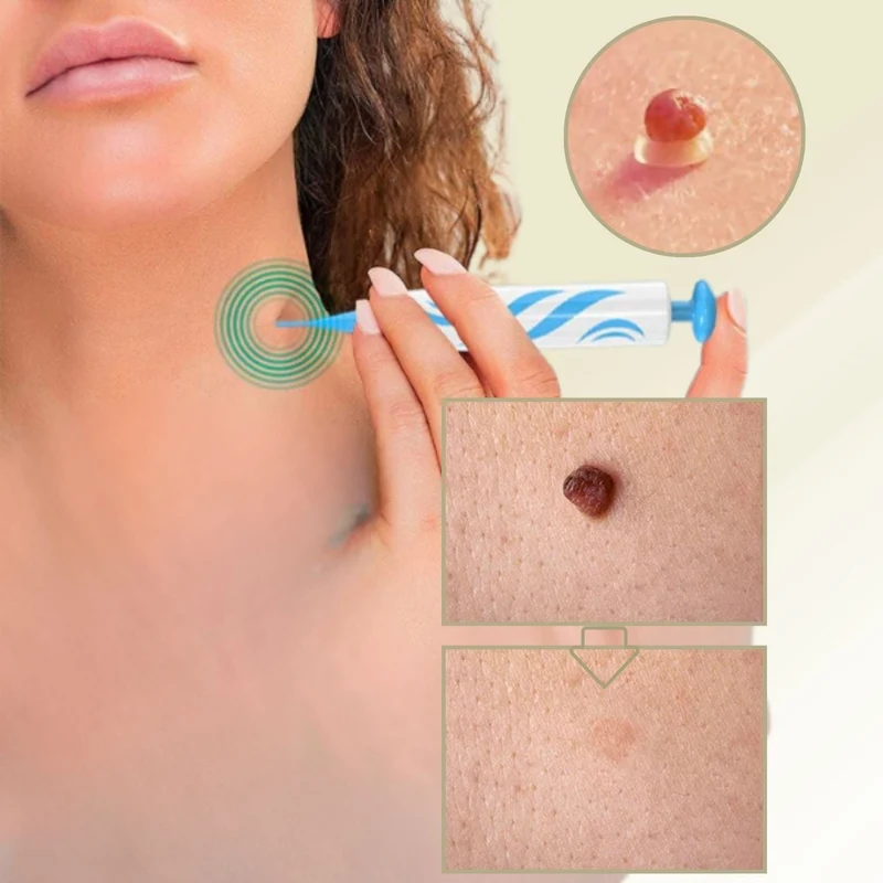 DermaLinx Rimuovi Verruche | Rimozione Indolore di Verruche e Nei | Per Casa | Senza Chirurgia